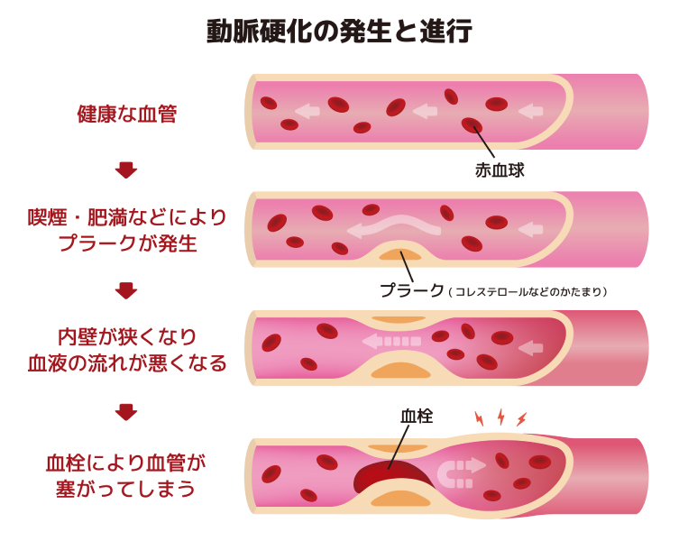 動脈硬化の発生と進行